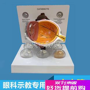 眼球模型白内障晶状体眼睛视力障眼底视网L膜眼科医生沟通医药促