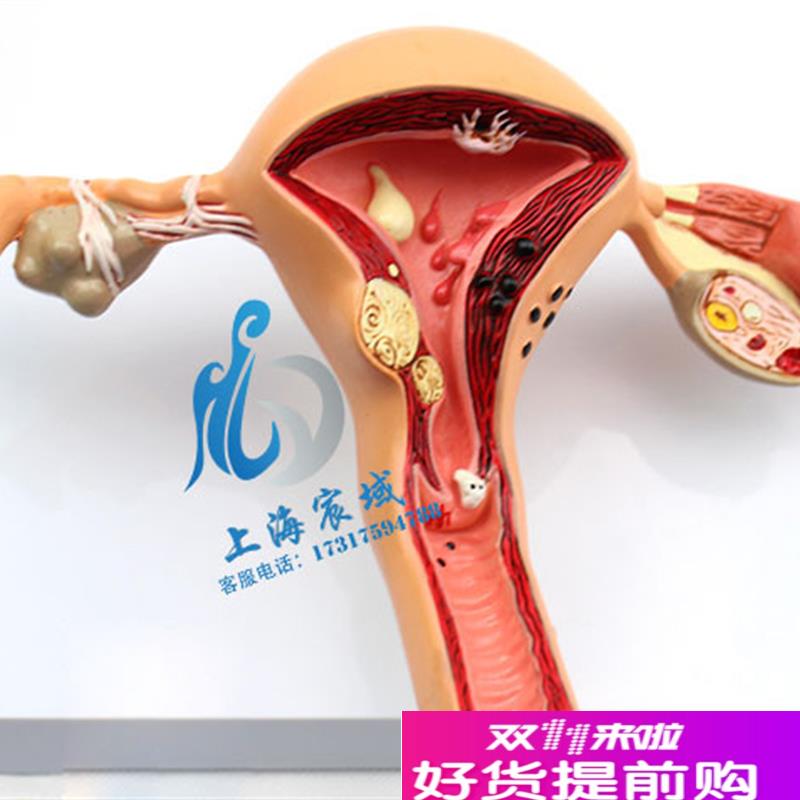 子宫卵巢病理病变模型生殖科女性内外生殖S器官模具教学病变