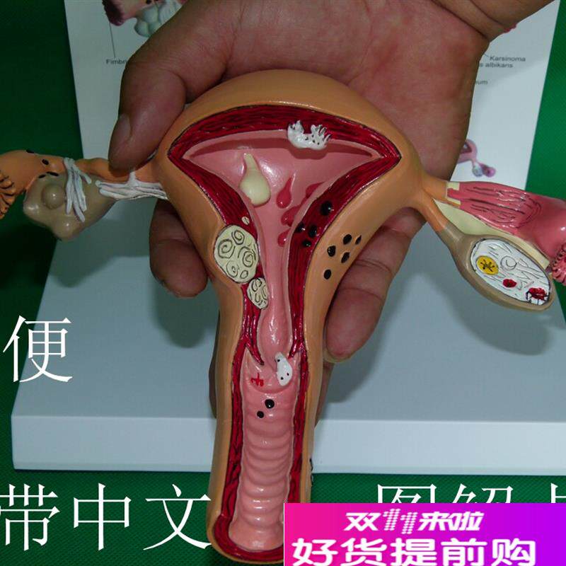 子宫卵巢病理病变模型生殖科医药