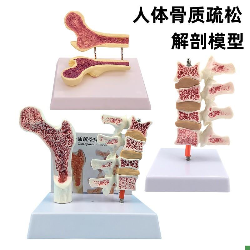 人体股骨骨质疏松解剖模型腿骨解D剖面脊柱切面标本病变腰椎模型