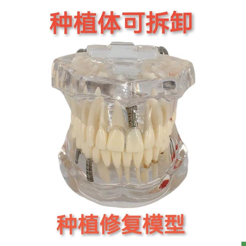 牙科材料修d复牙模型水晶病理牙模型活动种植牙模型包邮