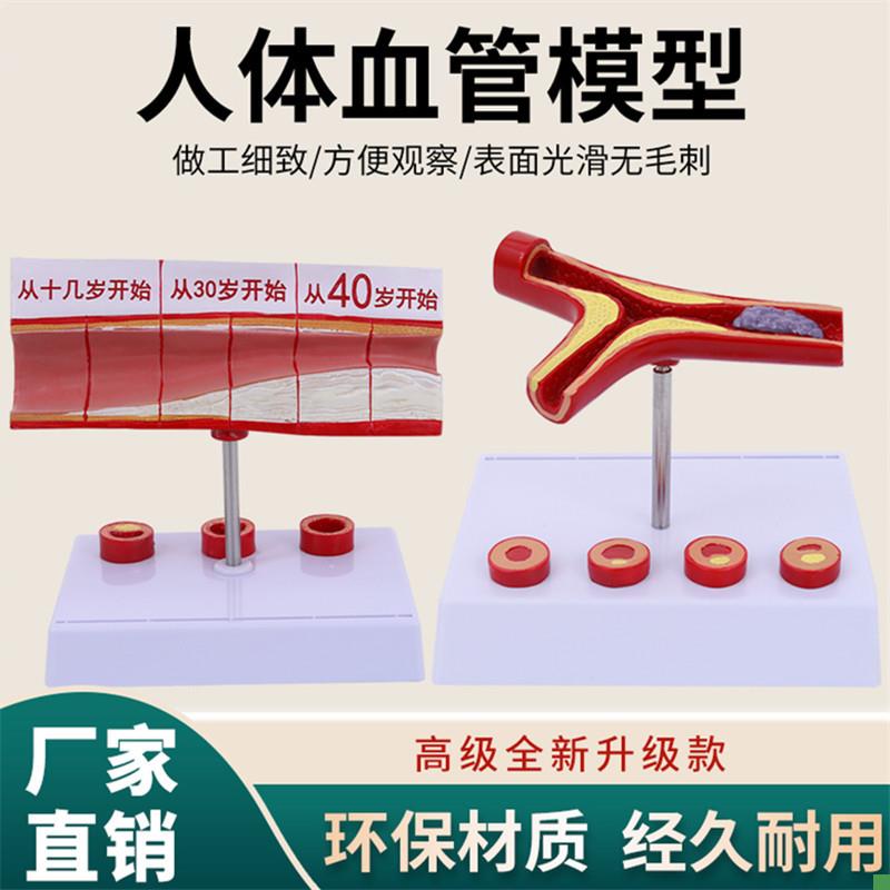 堵塞心血管模型关节血栓血液浓度脂肪病J理粥样硬化人体解剖教具