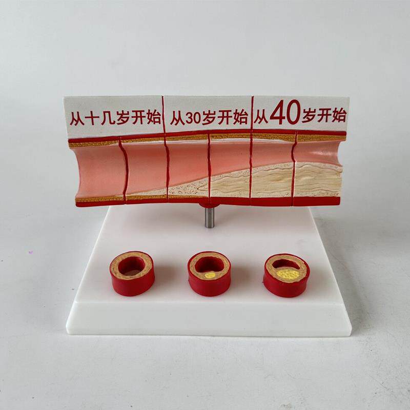 心脑血管堵塞模型关节血s栓血液浓度脂肪病理粥样硬化人体解剖教