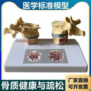 骨密度模型骨质结构疏松骨v小梁老年骨质变脆病理骨质医患股骨腰
