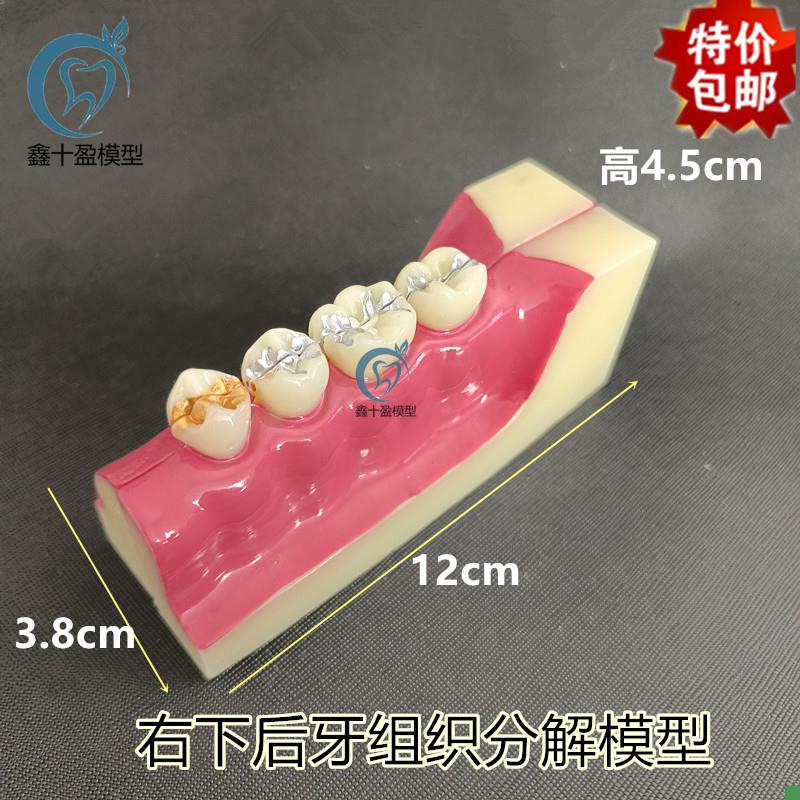 牙科右下后牙组织分解模型牙齿解剖J口腔教学可拆开牙齿模型