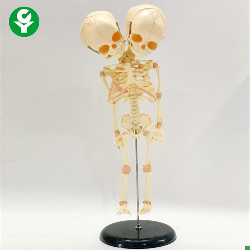 人体婴儿骨骼模型双头胎儿头骨畸形婴儿人骨架演V示教具胎儿头骨