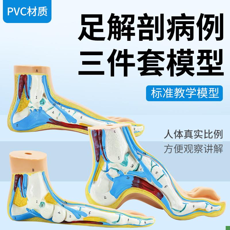 正常足扁平足弓形足模型/足弓模型解剖模型脚模Y型教学模型