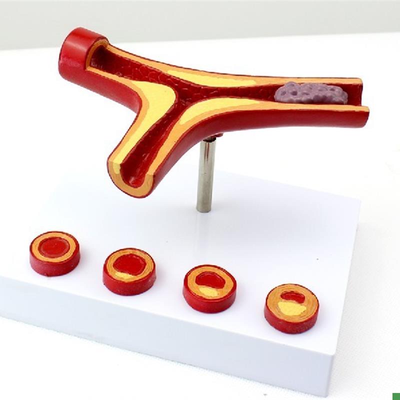 ENOVO颐f诺冠状动脉性心血管动脉硬化模型老年心脏模型血栓心内科