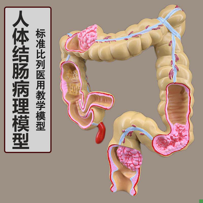 大肠病变病理解剖模型肠道疾病人体结肠病变模型R人体器官解剖模