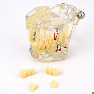 ENOVO颐诺口腔模型齿科种植阻生齿牙体牙髓口腔教V学马里兰桥瓷贴
