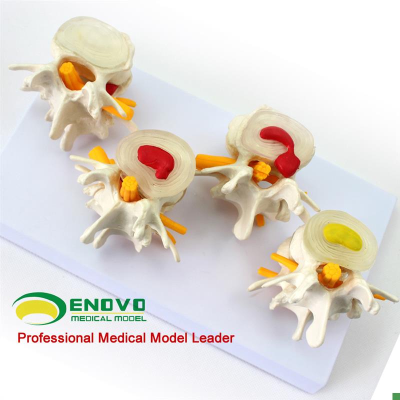 ENOVO颐诺医学人体腰椎模型椎体椎间盘病变R髓核膨出脱出软骨板