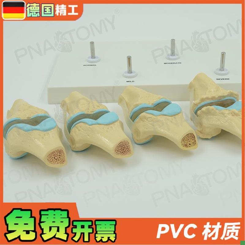 德国】人体膝关节骨骼p/病理模型关节骨质/病变教学膝盖骨外科疼