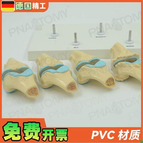 德国】人体膝关节骨骼p/病理模型关节骨质/病变教学膝盖骨外科疼