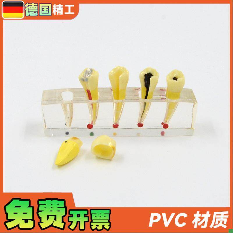 德国牙科医患沟通病理模型牙sui病修复L模型展示牙髓龋坏可拆