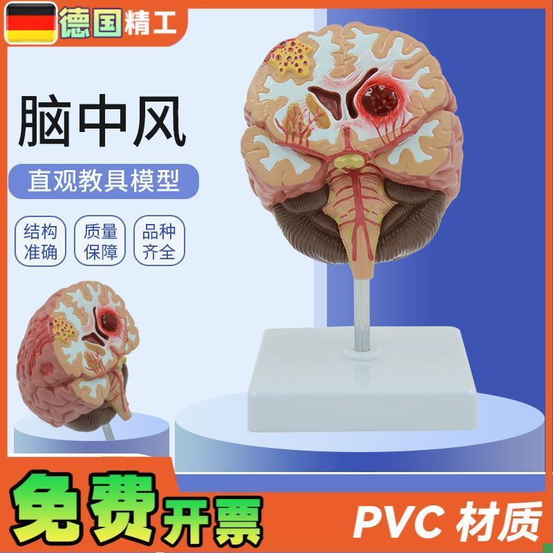 德国】人体脑解剖模n型脑出血动脉大脑动静脉畸形脑病理大脑教具