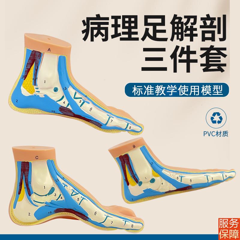 正常足 扁平足 弓型足 模型 足部病理模型人体足部解剖模型脚关节