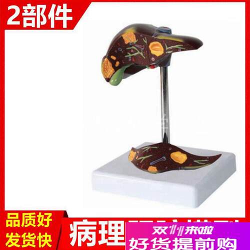 肝脏模型常见病理肝胆p血管脂肪临床医患教育肝结构解剖课教具消