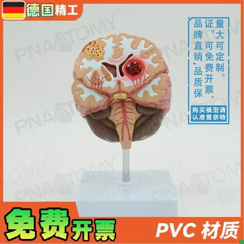 德国】人脑病理解剖模型脑geng大脑疾病L血管堵塞标本教学脑科神