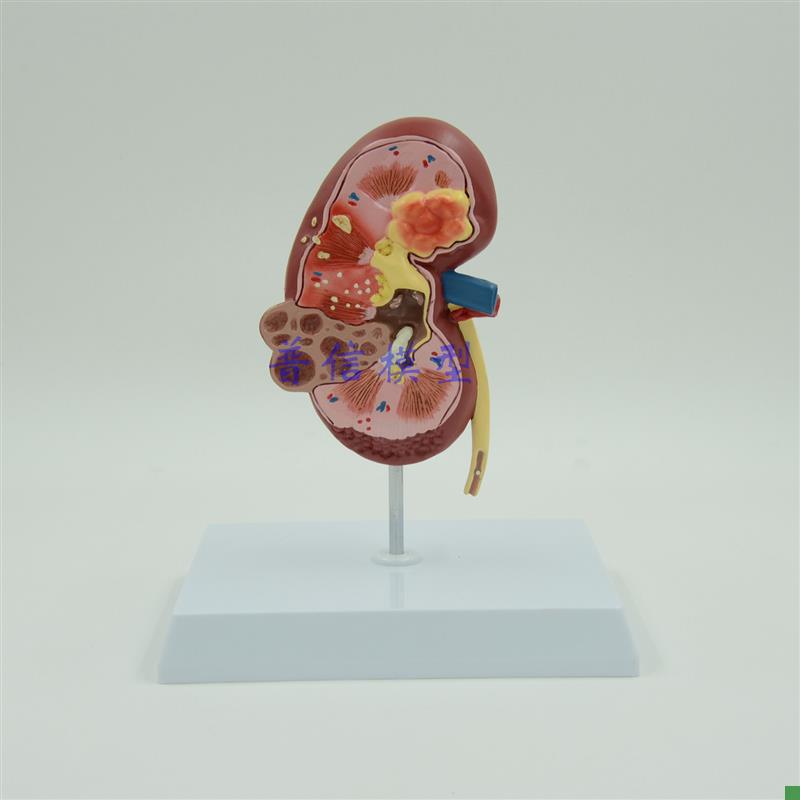 普信肾模型泌尿科教学自然大q肾脏模型泌尿系统肾结构医用