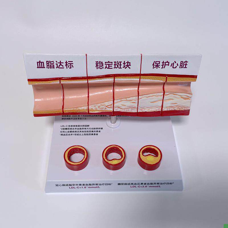 病理心血管模型粥样硬化脂肪斑块动脉内膜受损程度X医药促销礼品