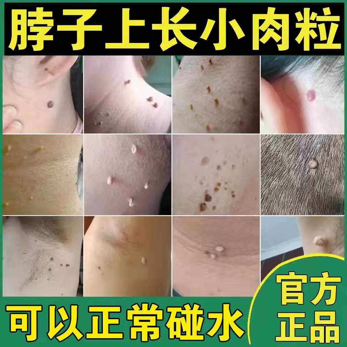 鬼臼毒素祛脖子上丝状刺猴皮赘肉痣肉芽皮肤长小肉粒疙瘩正品去除