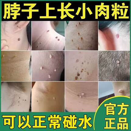 鬼臼毒素祛脖子上丝状刺猴皮赘肉痣肉芽皮肤长小肉粒疙瘩正品去除