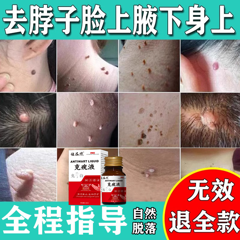 斑蝥素乳膏去猴子肉粒疙瘩小肉粒