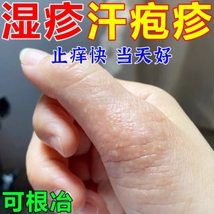 手上起小水泡汗泡疱止痒抑菌中药鹅掌风真菌感染手气湿痒疹专用膏