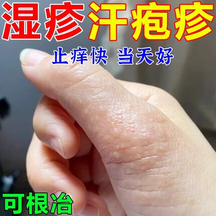 手上起小水泡汗泡疱止痒抑菌中药鹅掌风真菌感染手气湿痒疹专用膏