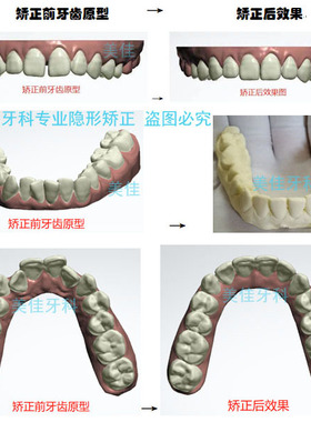 定做夜间防磨牙牙套睡觉磨牙颌垫咬合垫板牙齿防磨损保护神器大人