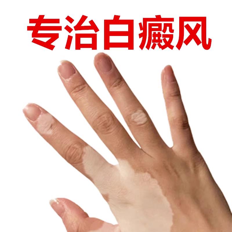 补骨脂白斑抑菌液白风外用酊膏促黑色素汗斑净专用手