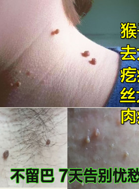 去扁平尤丝状尤跖尤去肉粒疙瘩肉刺去除猴子刺猴肉脖子肉痣点猴子