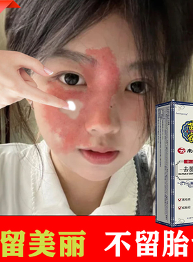 快速胎记去除神器脸部红咖啡斑太田痣膏黑色素鲜红斑淡化天生黑祛