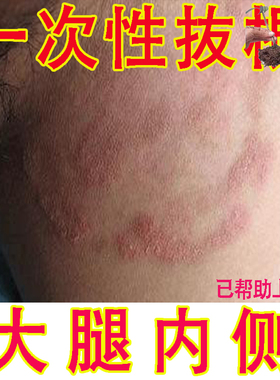 男士大腿内侧股藓专用膏皮肤瘙痒男性屁股湿止痒去慢性根效特
