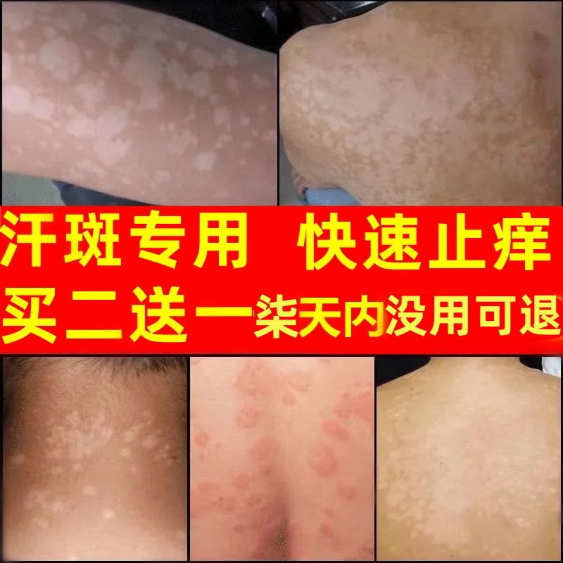 汗斑汗斑净汉斑专皂用露药香白斑皮肤消毒护理（消）