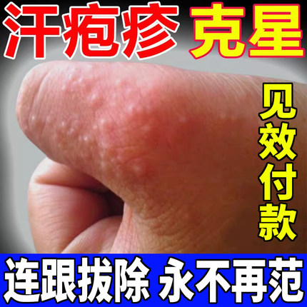 汗泡疱疹药膏手上起小水泡手痒汗状疱疹止痒汉状真菌感染专用软膏