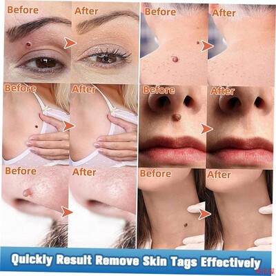 7Days Skin Tag Removal Serum Warts Remover Pen Painless Papi