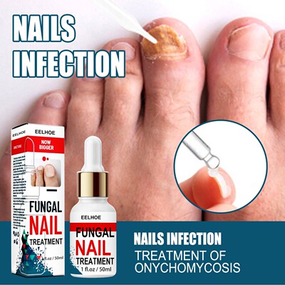 Nail Fungus Treatment Essence Serum Care Hand and Foot Care