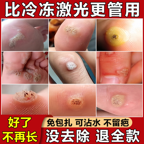 专去猴子用药跖疣膏瘊子祛除神器