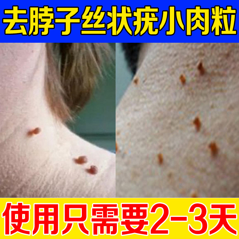 去脖子上长小肉球赘肉粒疙瘩点肉痣皮赘祛丝状尤灵去除膏神器颈部