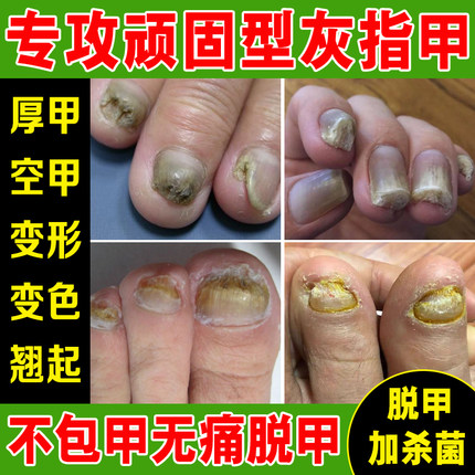 灰指甲专用脱甲膏去脚趾甲增厚甲无痛快速脱甲液嵌甲脚指甲软化剂