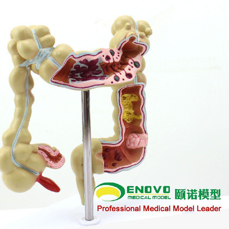 ENOVO颐诺医学用人体结肠病变模型 肛肠科 消化内科大肠模型 医生