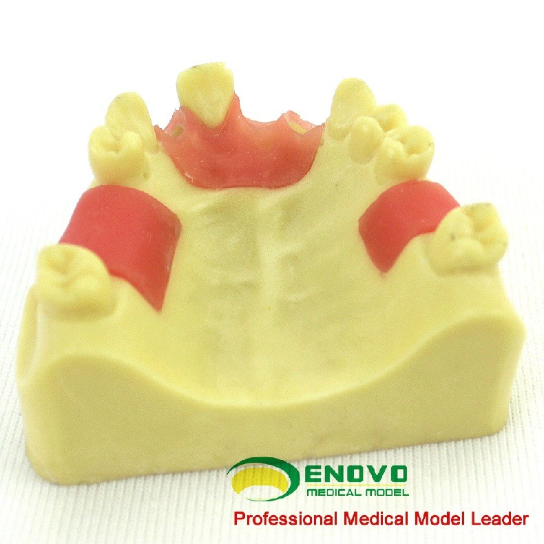 ENOVO颐诺牙医上颌缺失种植实训模型 口腔即刻种植培训 上颌骨缺