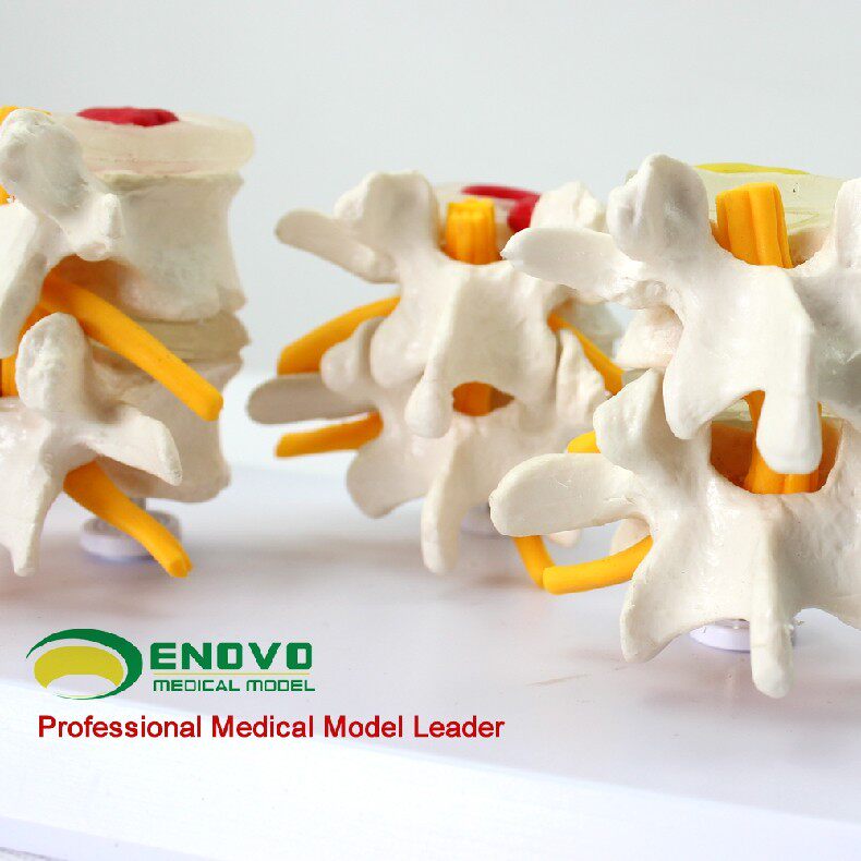 enovo颐诺医学人体腰椎模型 椎体椎间盘病变髓核膨出脱出软骨板纤