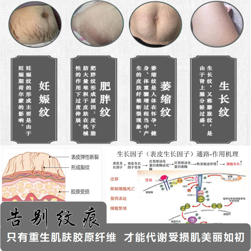 妊娠纹修复霜产后妊辰纹精油紧致去除肥胖纹大腿生长纹膨胀纹