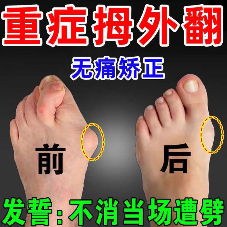 拇指外翻贴拇指外翻矫正神器大脚骨脚趾畸形重叠关节变形专用贴膏