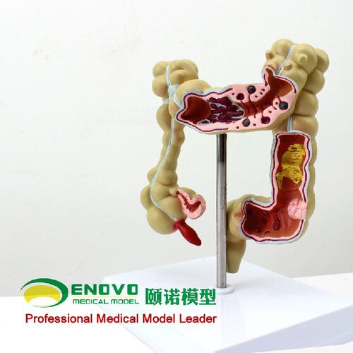 ENOVO颐诺人体结肠病变模型
