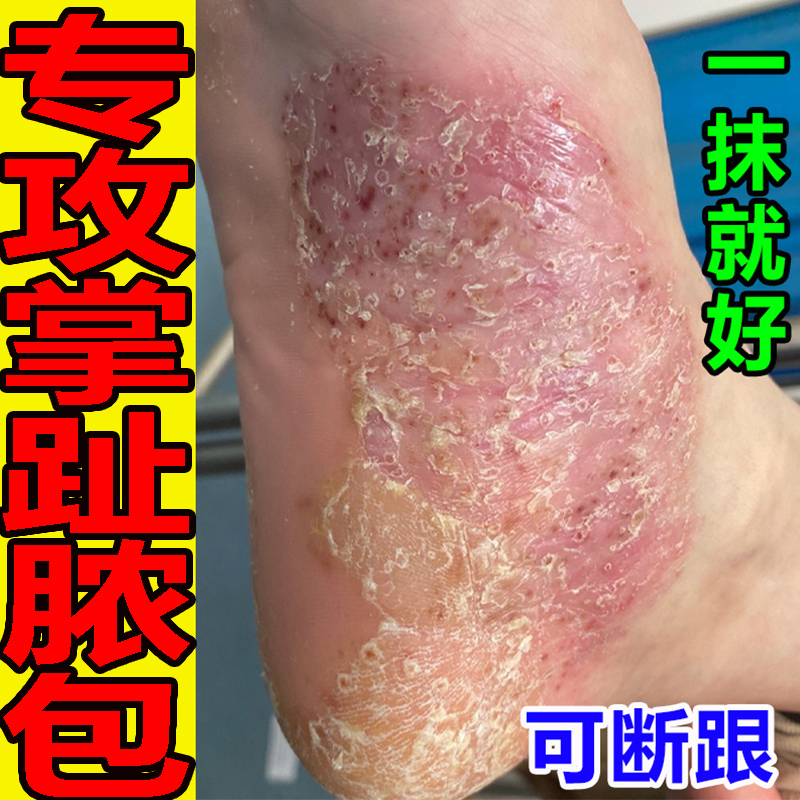 【掌趾脓疱】掌跖脓包病角化病症治疗手脚红斑脱皮干裂角皮症药膏