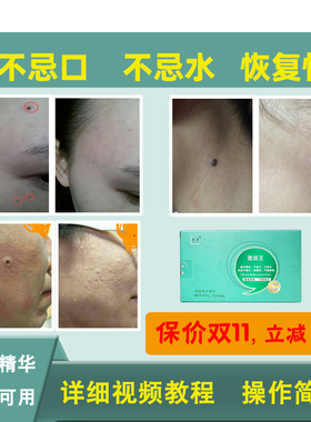 面康痣斑王各种痣小肉揪不忌水