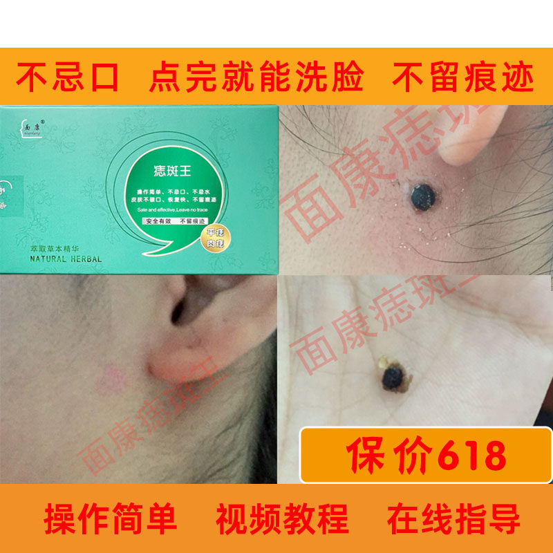 面康痣斑王点痣去痣祛黑痣扁平无痕小肉揪凸起老年斑无痕正品保障